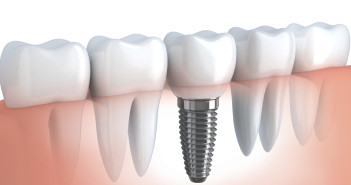 Dental implant