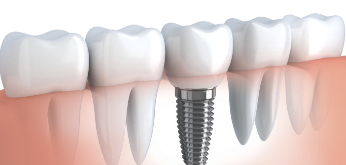 Dental implant