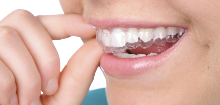 Invisalign: Does it Hurt Like Regular Braces? Braces Invis