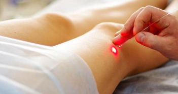 Varicose Vein Treatment