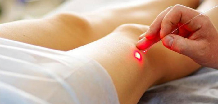 Varicose Vein Treatment: What to Ask Your Doctor Varicose Vein Treatment