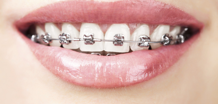 How the Types of Braces differ in Looks and Feel Braces