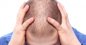 Thinning Hair