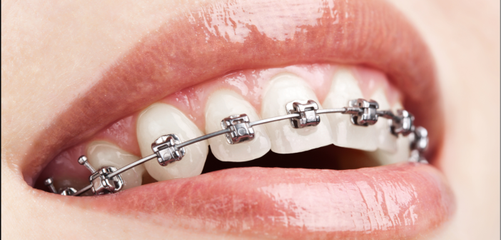 3 Fascinating Facts from the History of Braces Braces