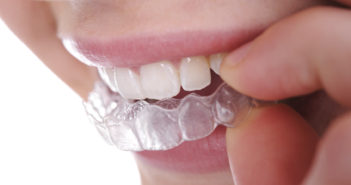 Invisalign