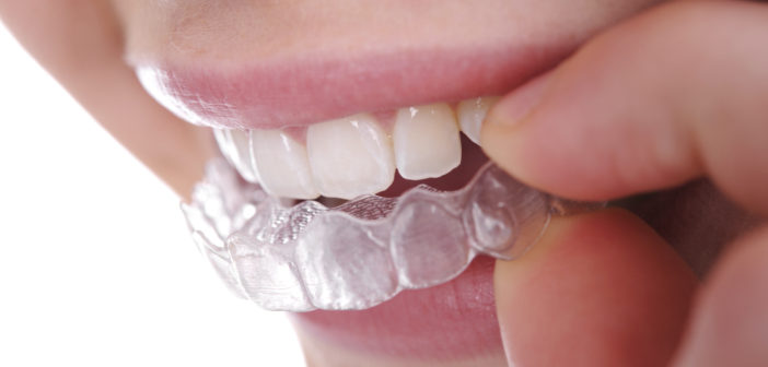 3 Main Reasons to Choose Invisalign over Ordinary Braces Invisalign