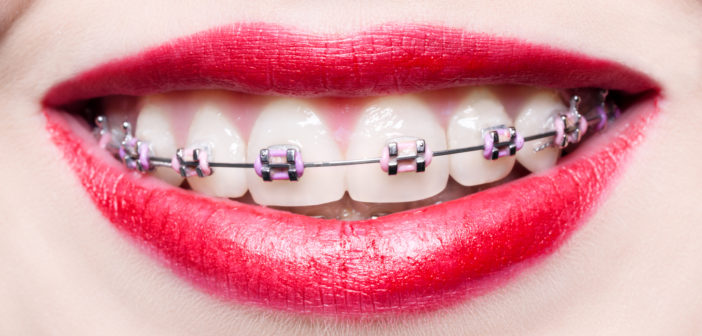 Teeth with braces